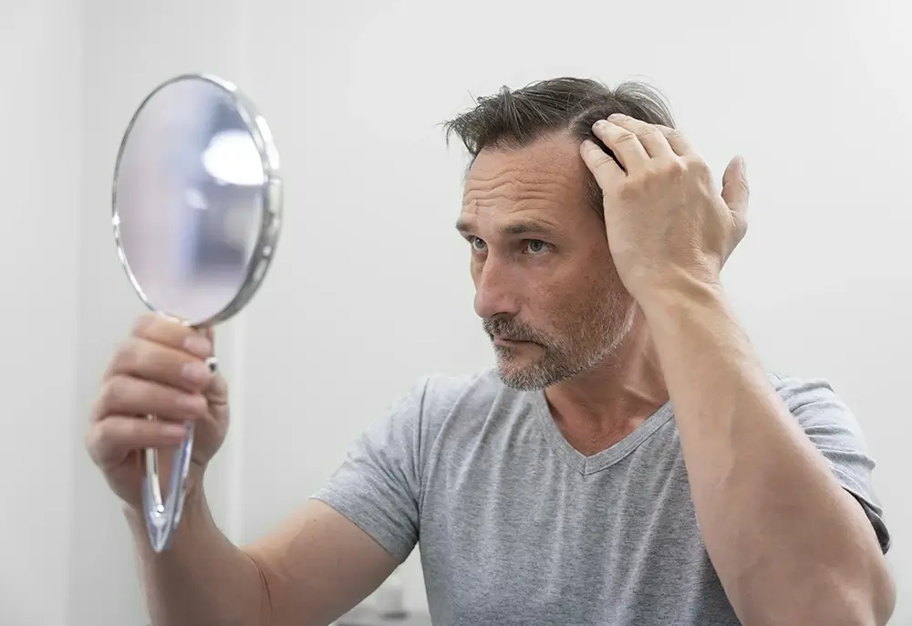 Los factores silenciosos que aceleran la calvicie en los colombianos