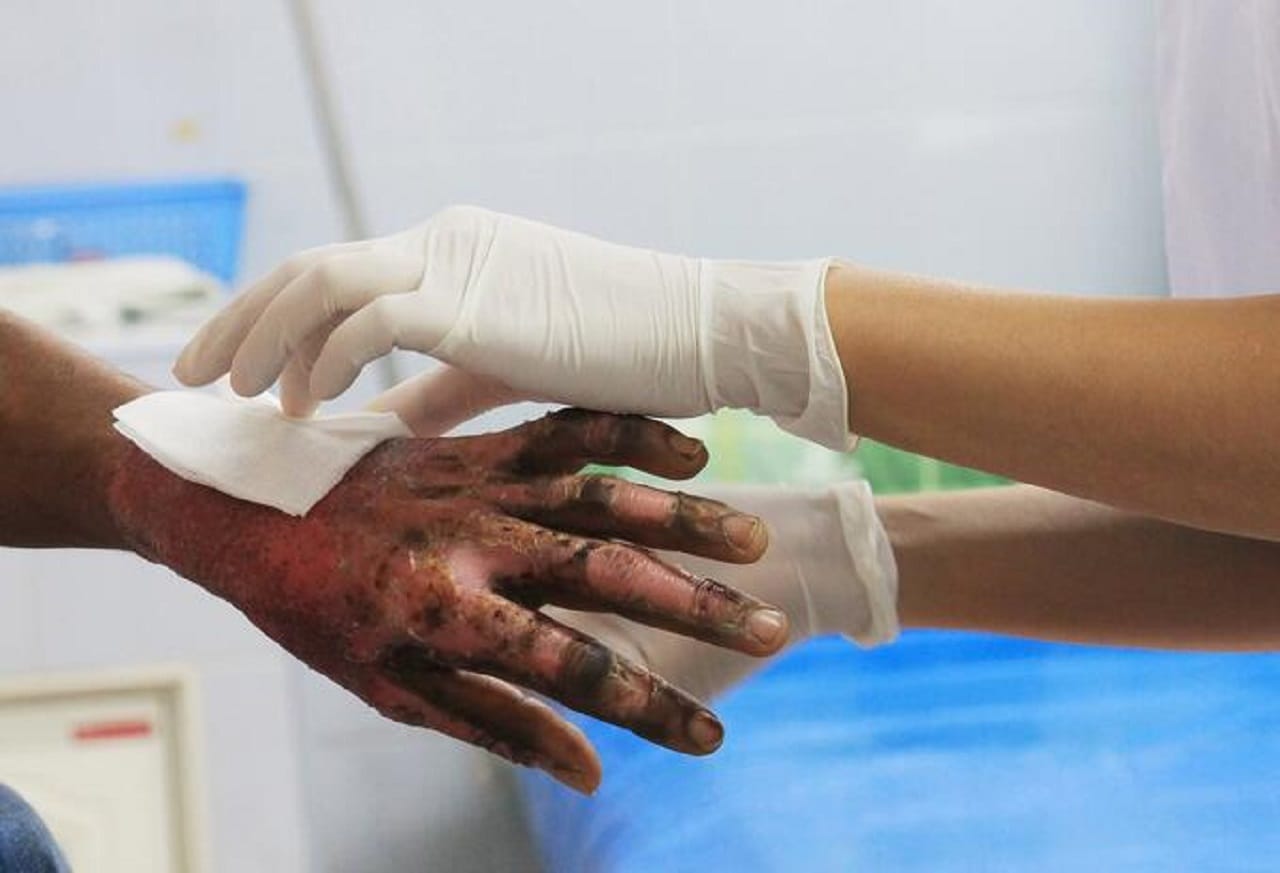 Preocupación tras aumento de quemados por pólvora en Santander: 18 personas entre ellas 7 menores