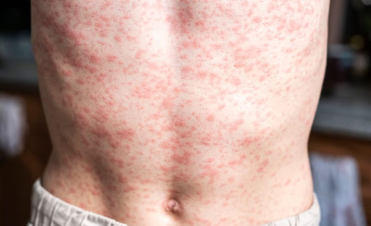 Alerta por caso importado de sarampión en ‘La Ciudad Bonita’