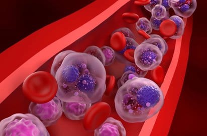 Diagnóstico temprano del mieloma múltiple puede evitar daños irreversibles en pacientes