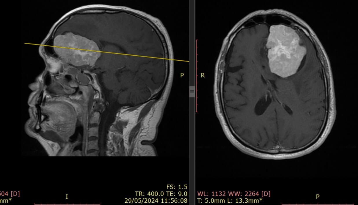 Convulsiones y dolores de cabeza inusuales: señales que podrían alertar sobre un tumor cerebral