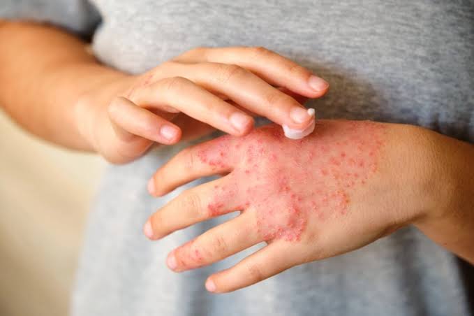 La dermatitis atópica afecta a uno de cada cinco niños en Colombia
