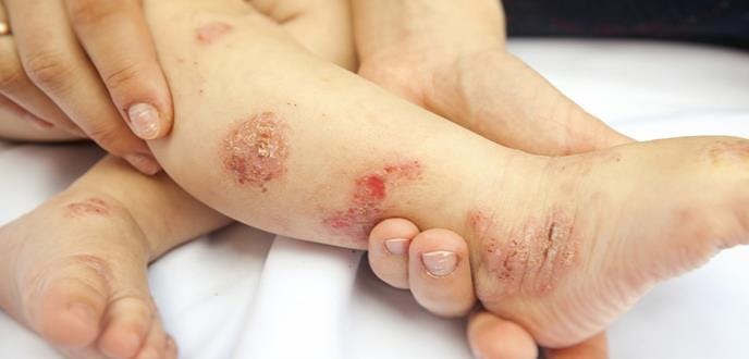 Dermatitis atópica en niños podría estar relacionada con otras enfermedades alérgicas