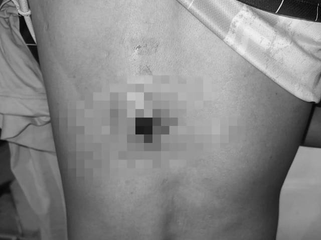Le dispararon en la espalda por intentar evitar el robo de su moto en Barrancabermeja