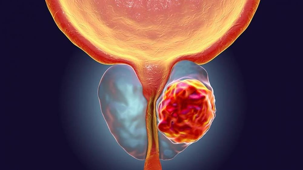 Detección temprana del cáncer de próstata imagen de la publicación