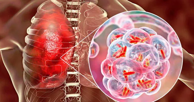 Alerta en Santander: 350 casos de tuberculosis en lo que va del año imagen de la publicación