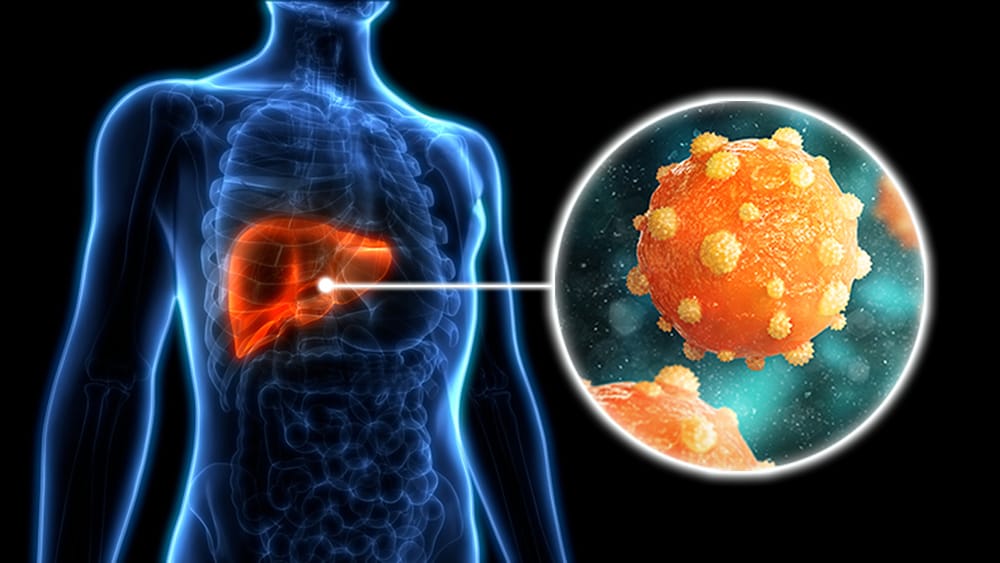 Hepatitis: la amenaza silenciosa que cobra una vida cada 30 segundos imagen de la publicación
