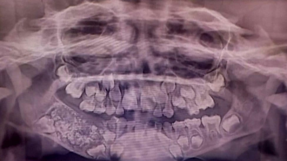 ¡Insólito! Niño fue operado para extraerle 526 dientes imagen de la publicación
