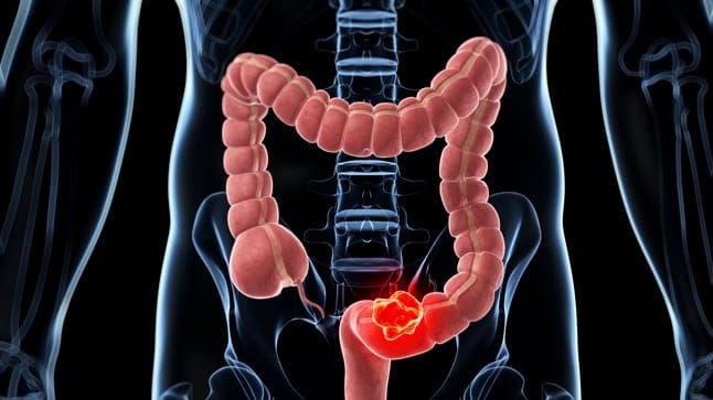 Cáncer de colon: síntomas que no deben ignorarse y cómo prevenir una de las principales causas de muerte en el mundo imagen de la publicación