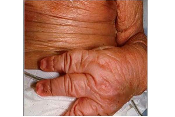 Gobierno reporta disminución de mortalidad en personas con Enfermedades Huérfanas imagen de la publicación