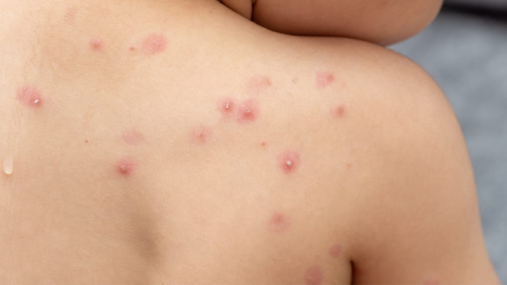 Viruela símica mantiene bajo alerta al sistema de salud de Santander imagen de la publicación