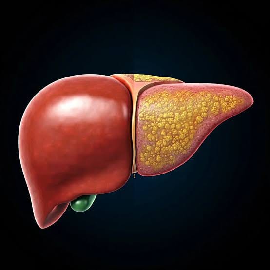 Más de 7 millones de colombianos podrían padecer hígado graso asociado a disfunción metabólica imagen de la publicación