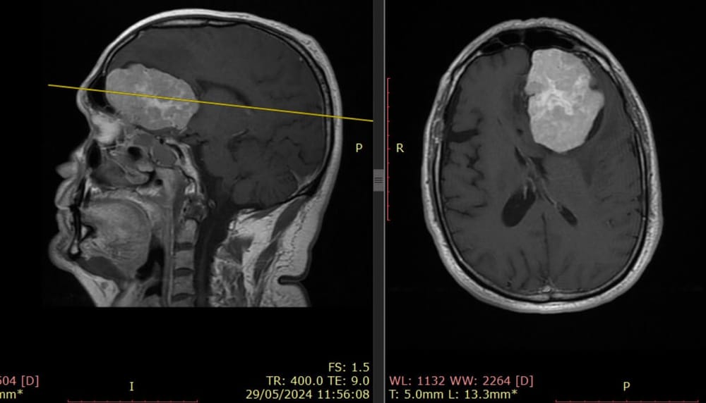 Convulsiones y dolores de cabeza inusuales: señales que podrían alertar sobre un tumor cerebral imagen de la publicación