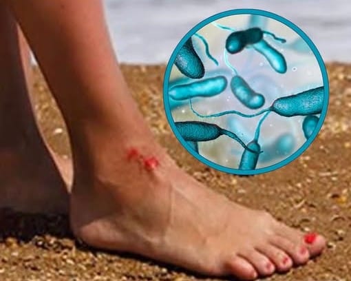 Alertan a bañistas de bacteria carnívora en aguas costeras imagen de la publicación