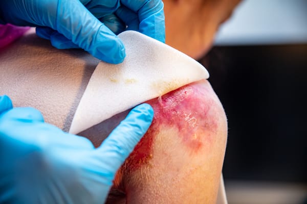 La Epidermólisis Bullosa y el poder transformador de la tecnología