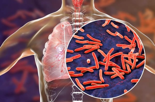 Día mundial de la tuberculosis: ¿cómo actuar contra esta enfermedad?