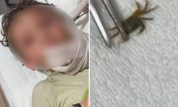 ¡Qué susto!: médicos extraen un cangrejo vivo del oído de un niño
