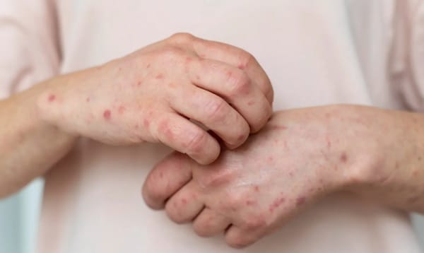 Preocupante reporte sobre casos de varicela en Santander