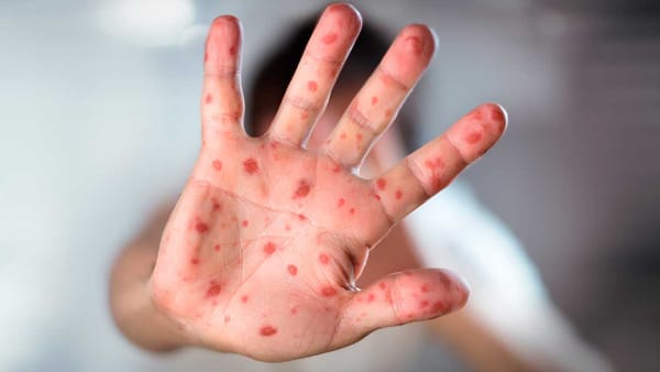 Aumento de casos de sarampión mantiene en nerviosismo médico a las autoridades en Colombia