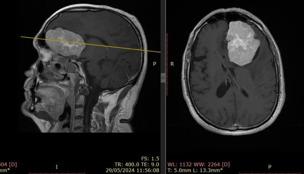 Convulsiones y dolores de cabeza inusuales: señales que podrían alertar sobre un tumor cerebral