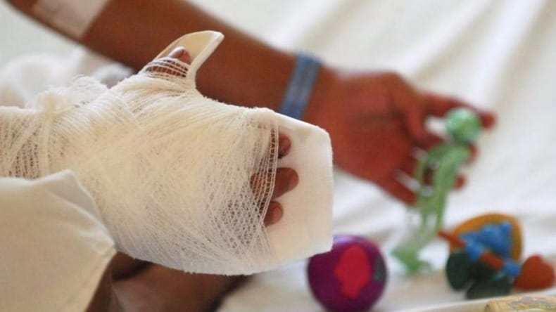 Lo que nadie cuenta sobre las quemaduras con pólvora imagen de la publicación