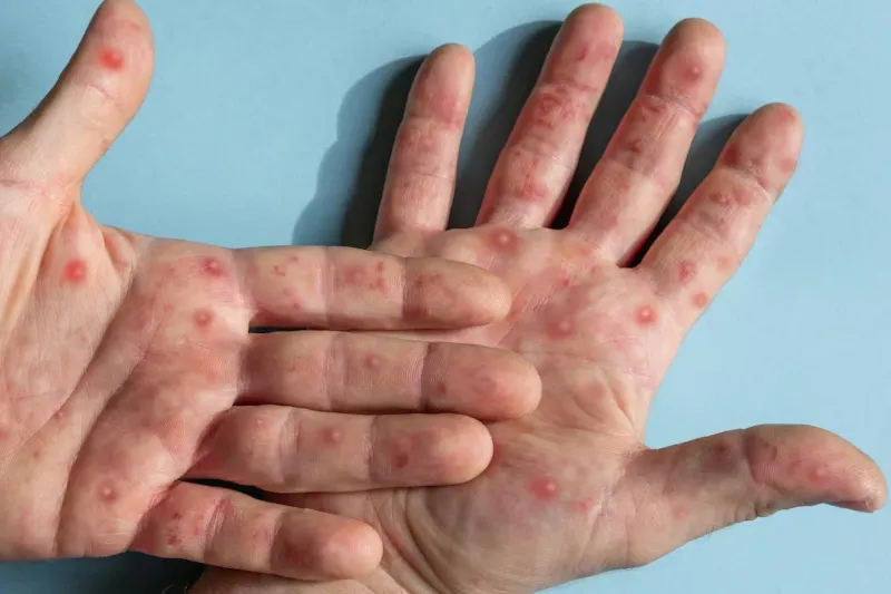 Alerta por detección de peligrosa variante de viruela símica en Colombia imagen de la publicación