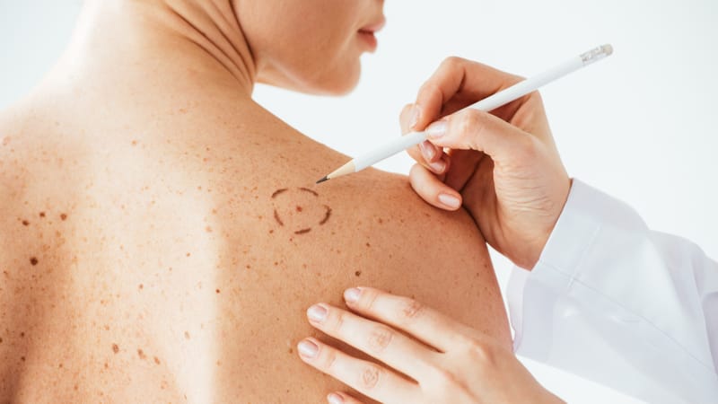 El cáncer de piel causa estragos en Bucaramanga imagen de la publicación